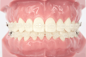 大人の矯正装置 | 新川崎おおき矯正歯科