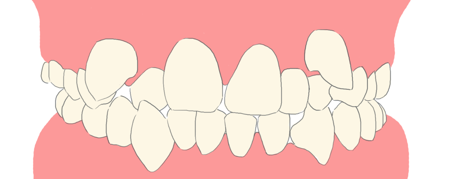 ガチャ歯 八重歯を矯正治療で治したい方へ抜歯や費用について解説 新川崎おおき矯正歯科
