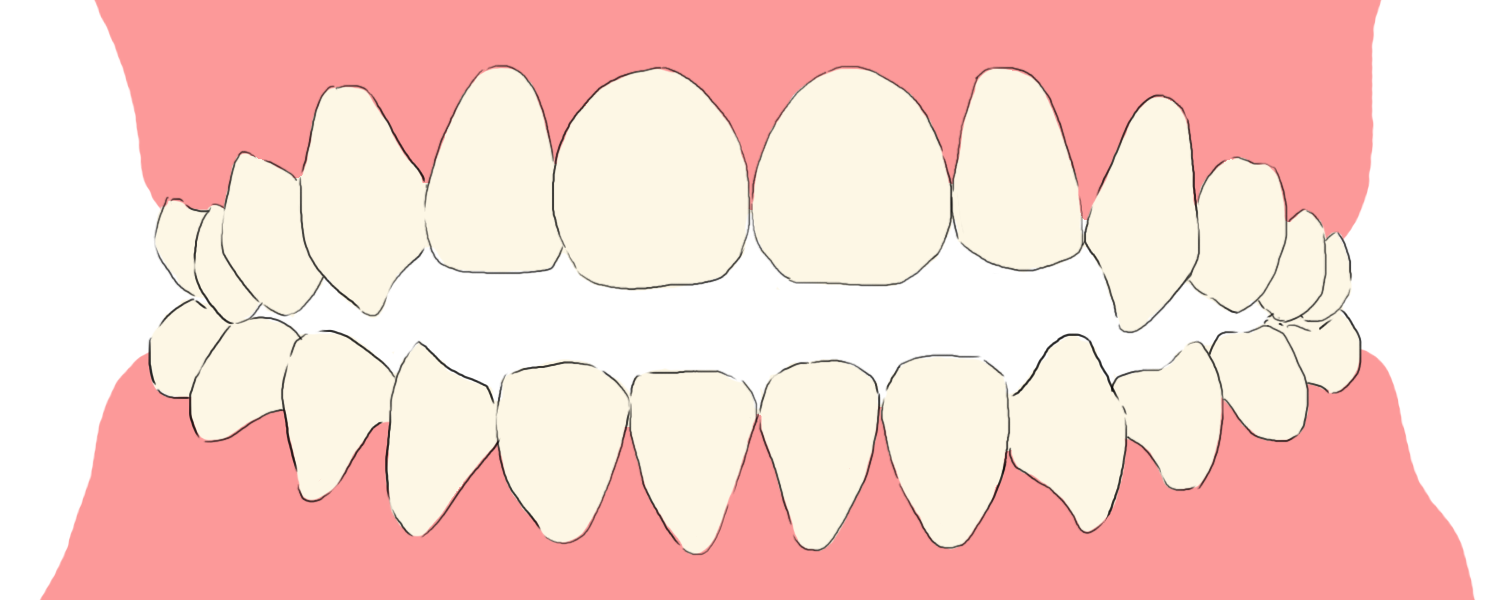 開咬 前歯が噛み合わない の原因や矯正治療の費用や期間について解説 新川崎おおき矯正歯科