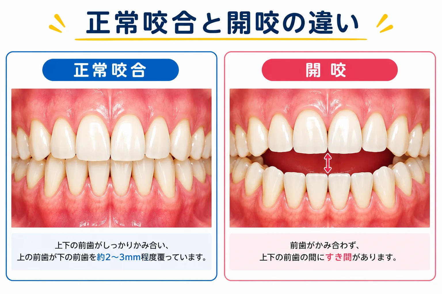正常咬合と開咬の違いを正面から比較した図