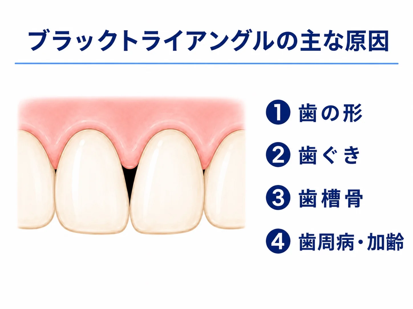 ブラックトライアングルの主な原因である歯の形・歯ぐき・歯槽骨・歯周病や加齢を示した図