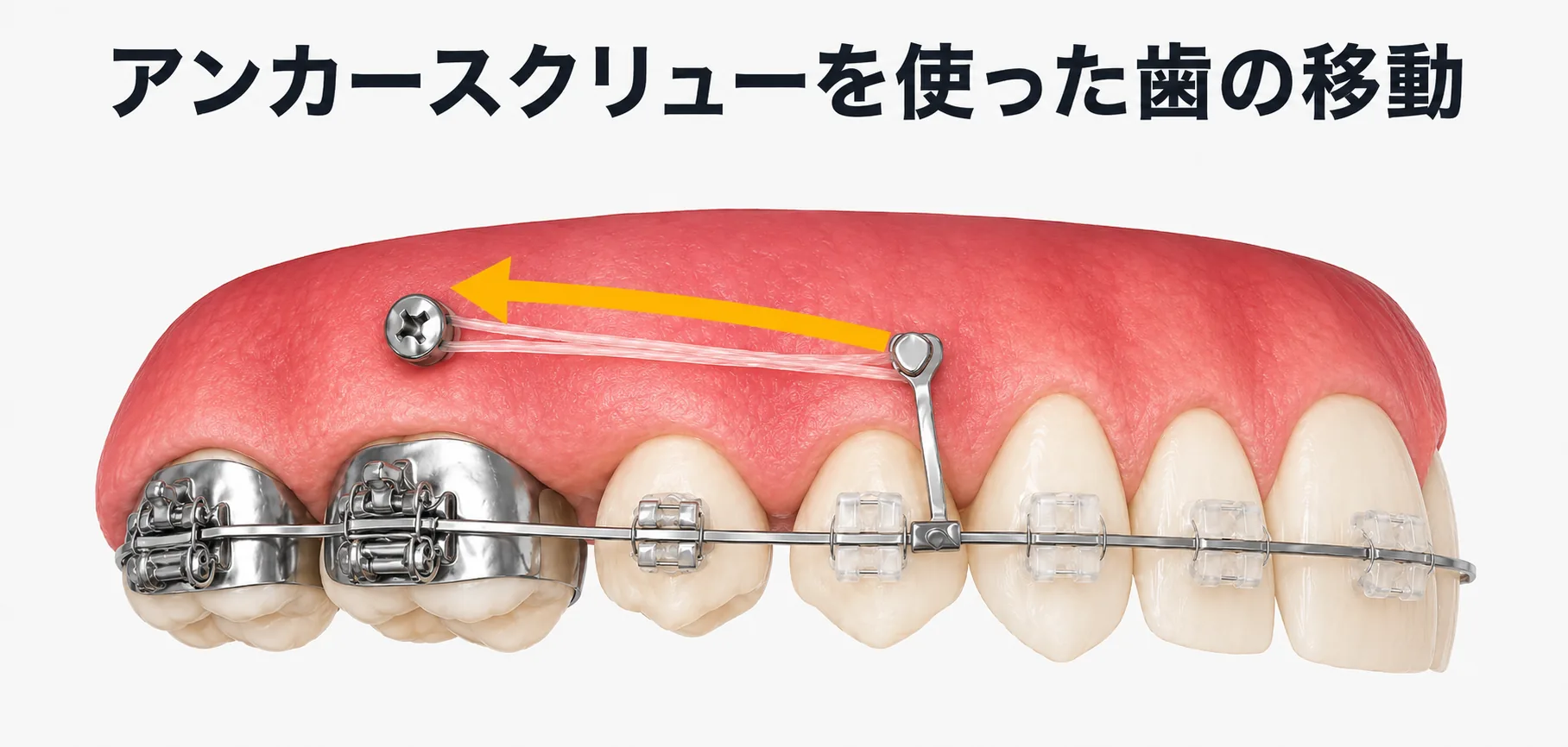 歯科矯正用アンカースクリューってどんなもの？ | 新川崎おおき矯正歯科