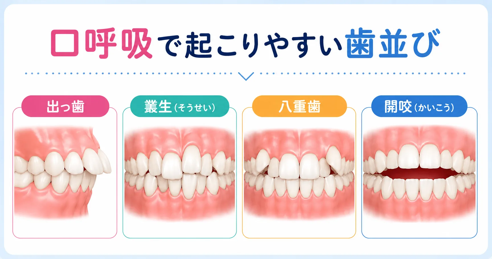 口呼吸で起こりやすい歯並び(出っ歯・叢生・八重歯・開咬)