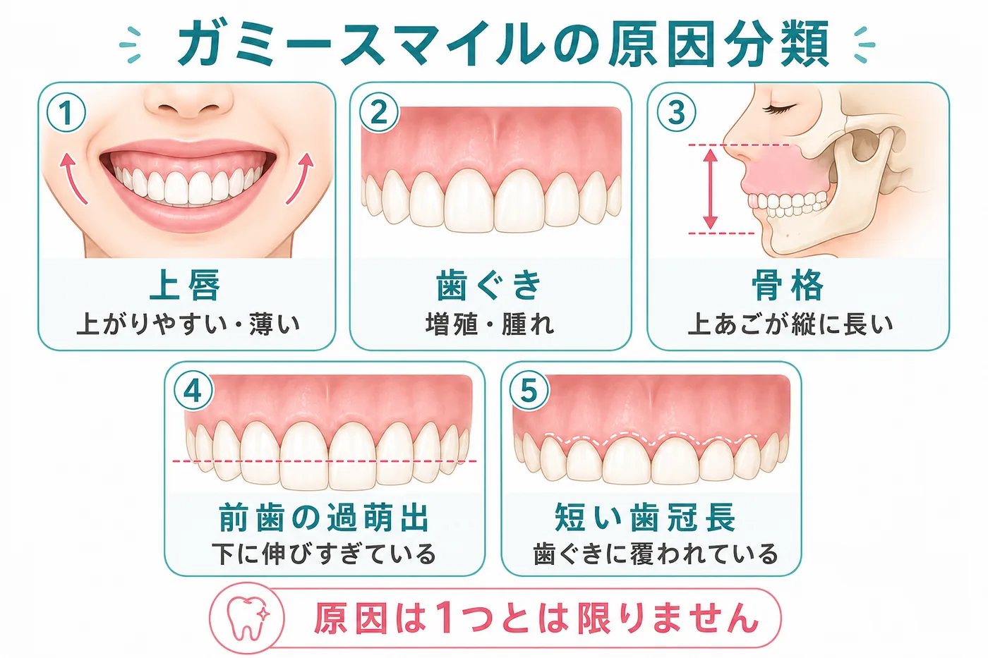 ガミースマイルの主な原因を唇・歯ぐき・骨格・前歯・歯の形に分けて示した図