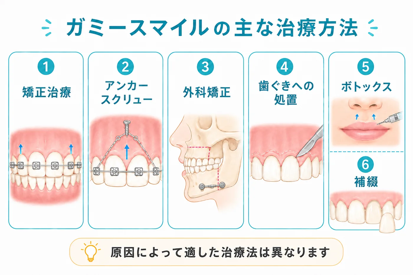 ガミースマイルの治療方法を原因別に整理した図