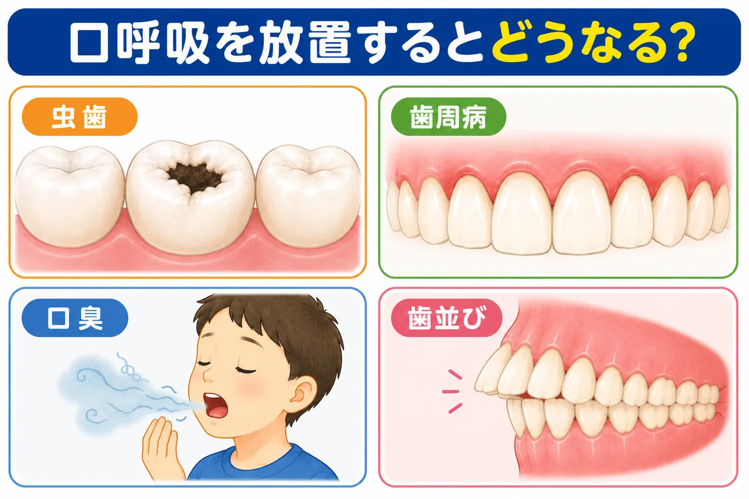 口呼吸を放置した場合に起こりやすい虫歯・歯周病・口臭・歯並びへの影響