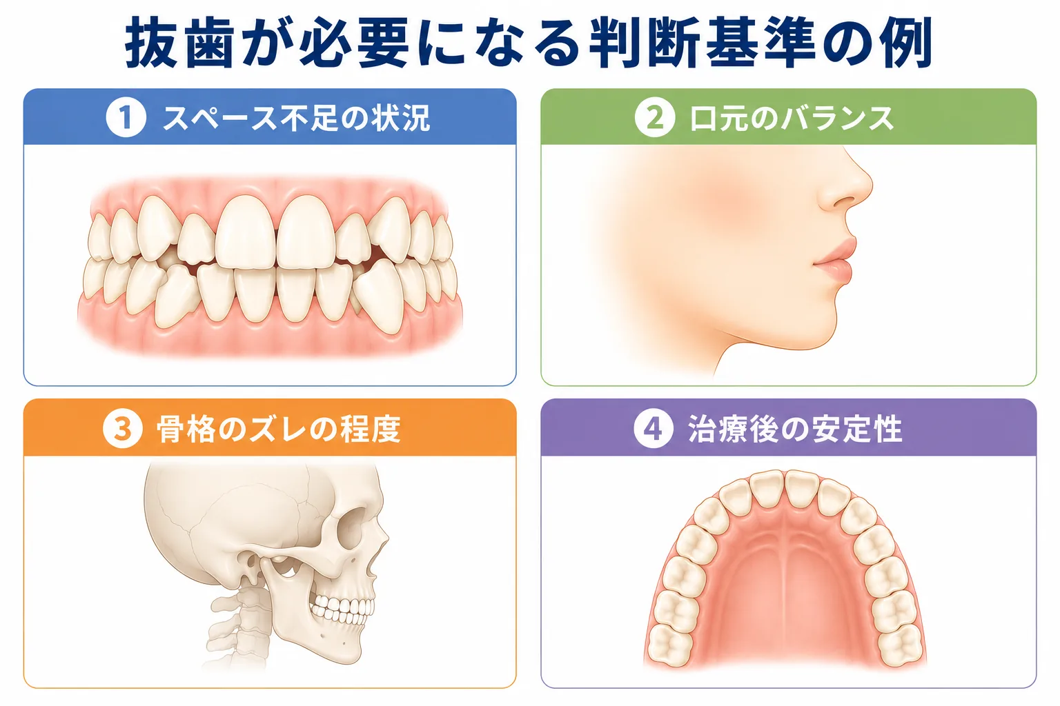 抜歯矯正で抜歯が必要になる判断基準の例を示したイラスト