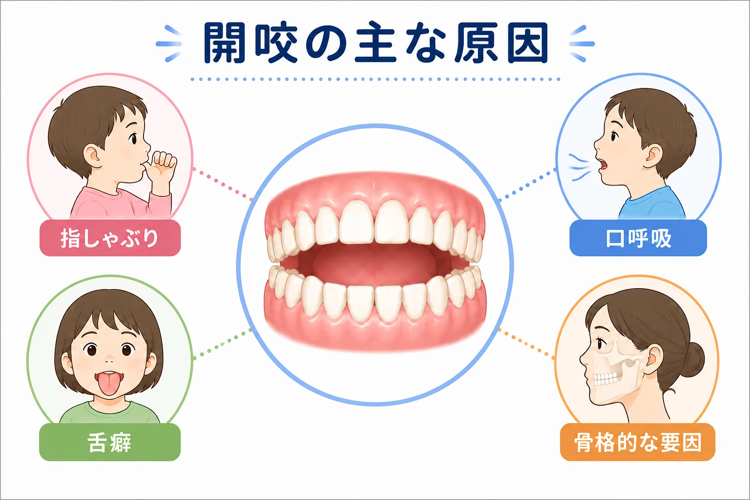 開咬の主な原因である指しゃぶり・舌癖・口呼吸・骨格的な要因を示した図